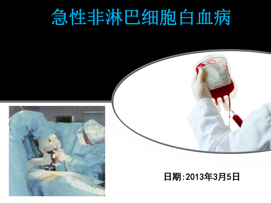 急性非淋巴细胞白血病PPT.ppt_第1页