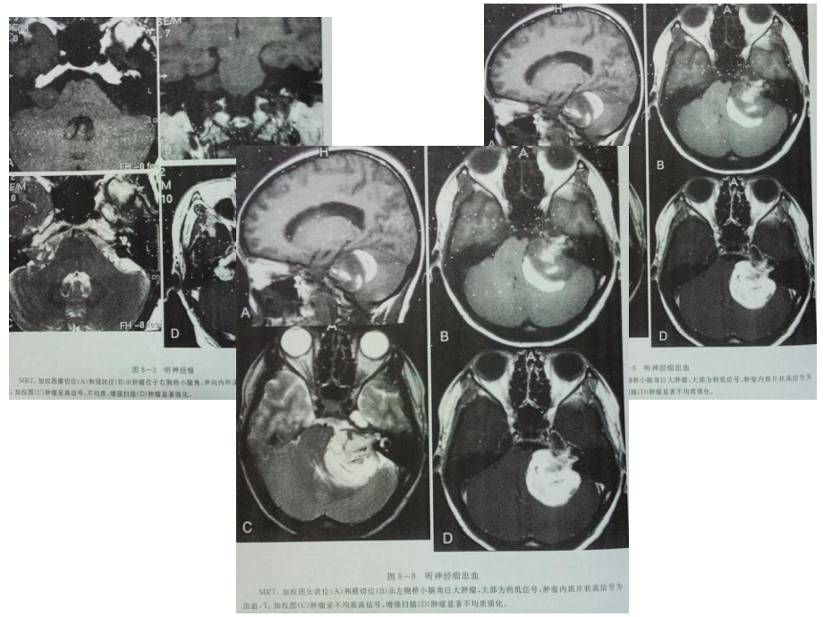 桥小脑角区占位病变.ppt_第3页