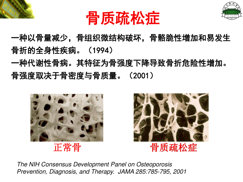 原发性骨质疏松症(修改).ppt_第3页