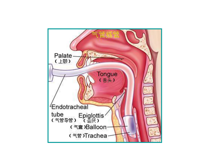 气管插管快速上手必读.ppt_第2页