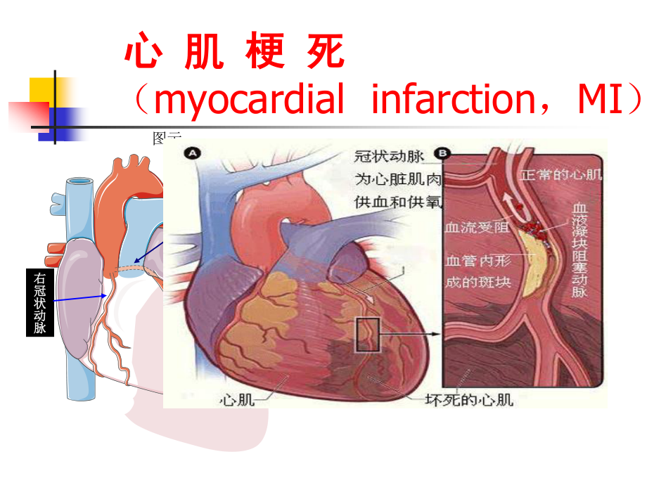 急性心肌梗死.pptx_第2页