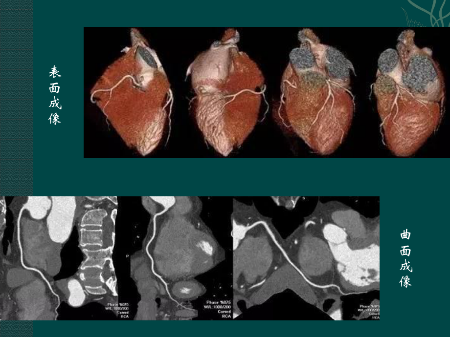 如何看冠脉CTA.pptx_第3页