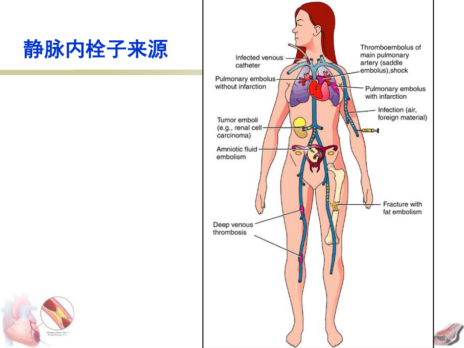 局部血液循环障碍-栓塞与梗死.ppt_第3页