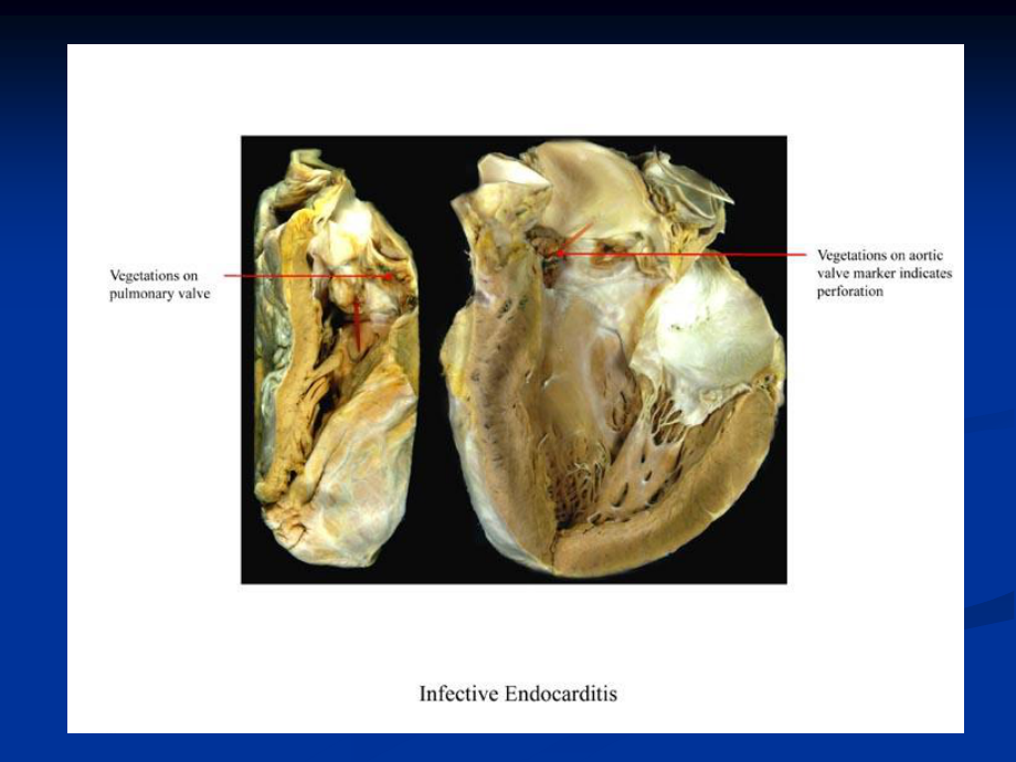 感染性心内膜炎2010.ppt_第3页