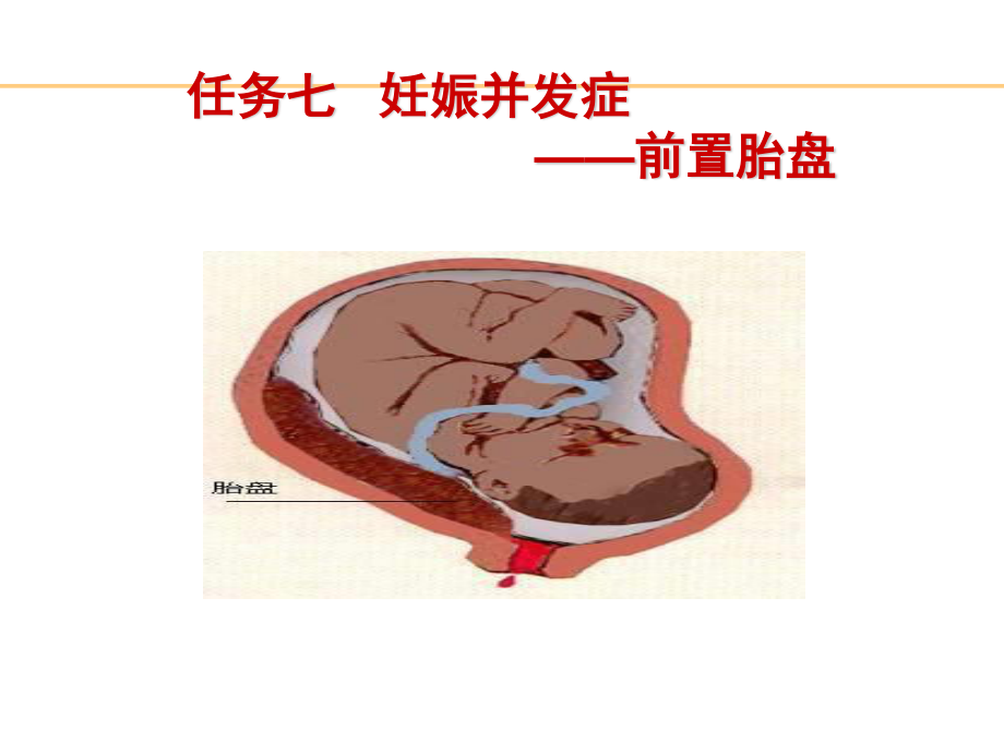 妊娠并发症之前置胎盘.ppt_第2页