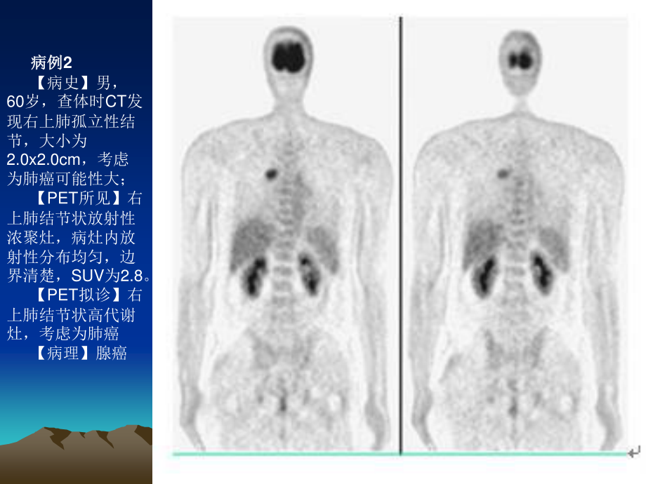 最新PET病例-PPT文档.ppt_第1页