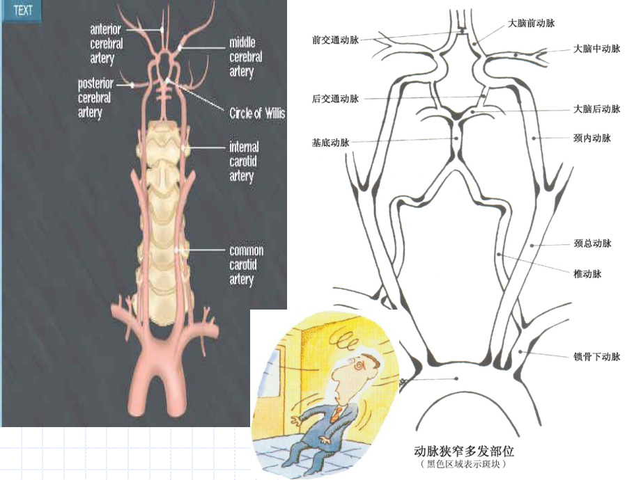 后循环缺血专家共识(2006年).ppt_第3页