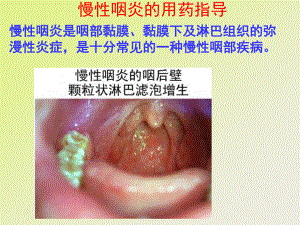 慢性咽炎的用药指导剖析.ppt