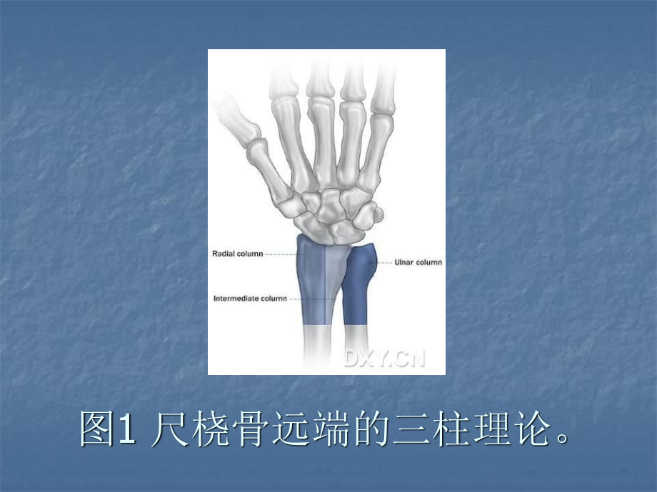 桡骨远端骨折应用锁定钢板手术方法.ppt_第2页