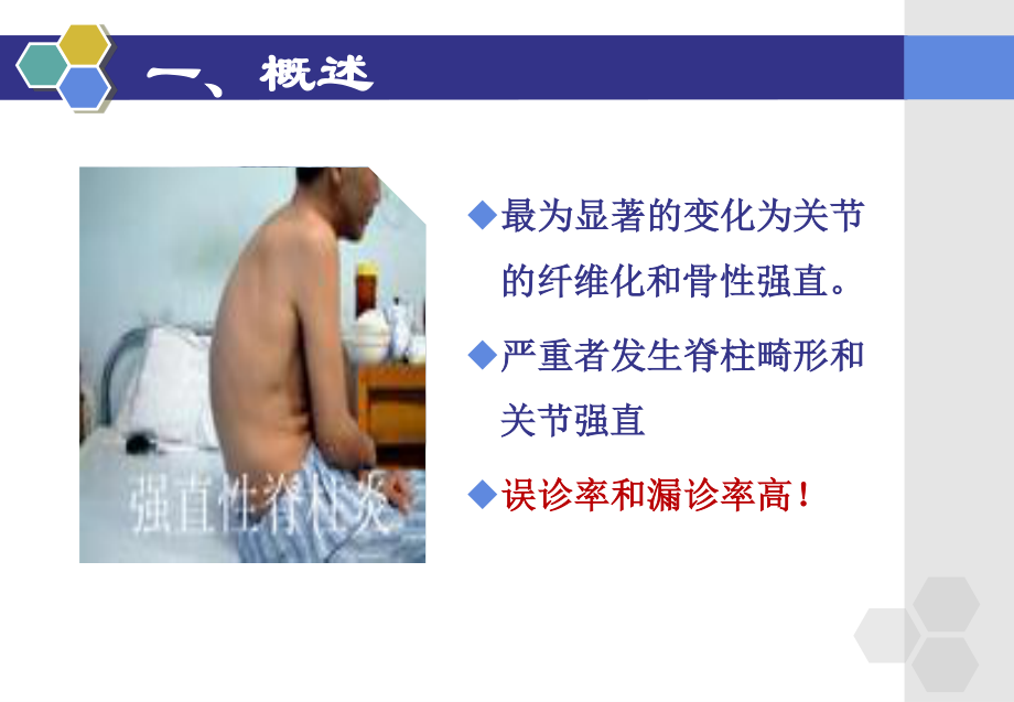 强直性脊柱炎的概述..ppt_第3页