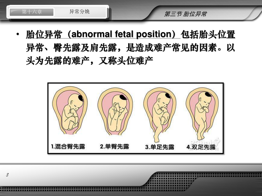 异常分娩-胎位异常.ppt_第3页