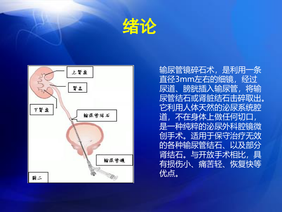 输尿管镜碎石术.ppt_第2页