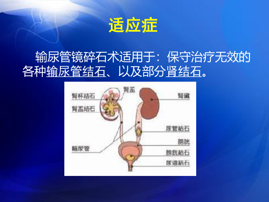 输尿管镜碎石术.ppt_第3页