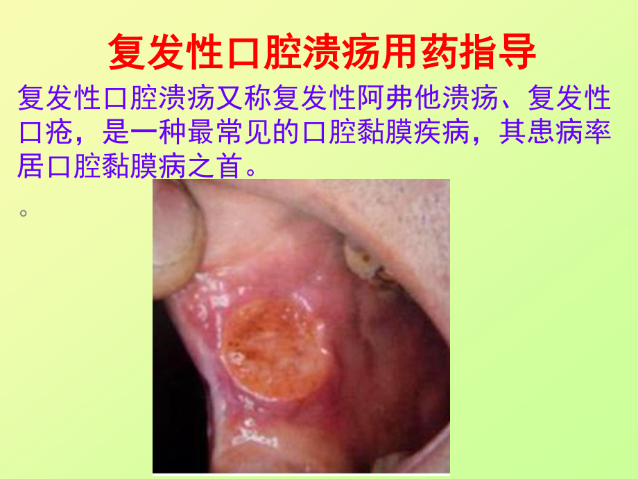 复发性口腔溃疡用药指导.ppt_第1页