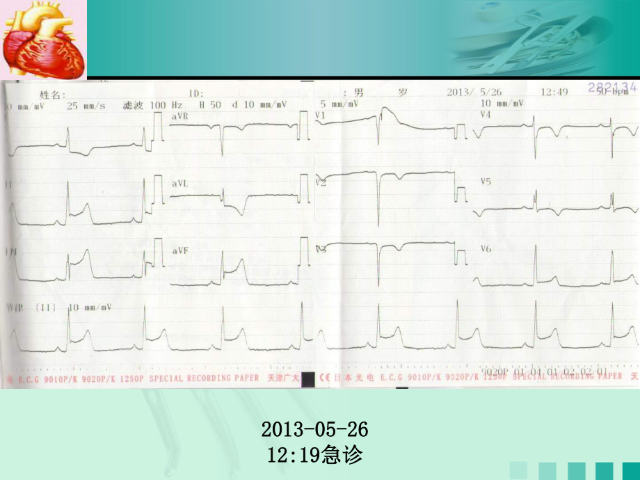 广泛前壁心肌梗死病案讨论.ppt_第3页