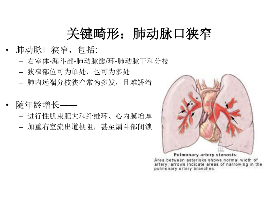 法洛四联症.ppt_第3页