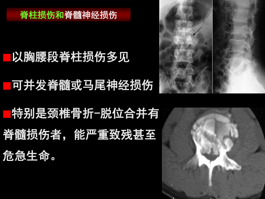 四肢脊柱骨折的紧急处理.ppt_第3页