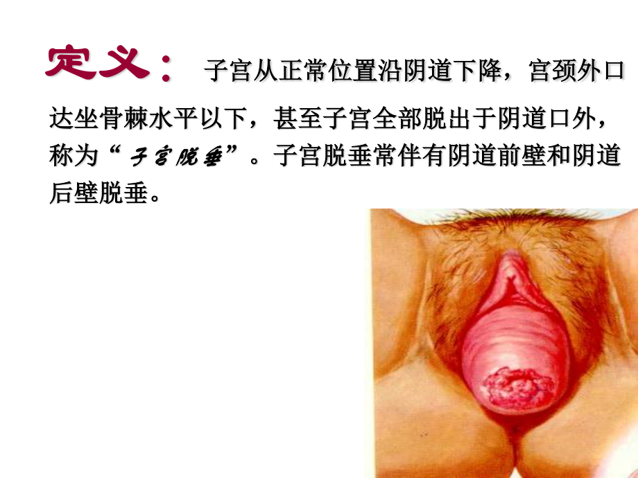 子宫脱垂宋丽丽ppt.ppt_第3页