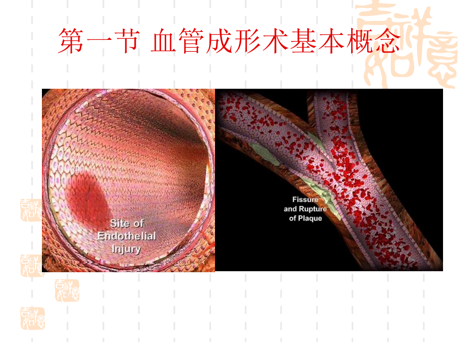 血管成形术及支架植入术-修改.ppt_第3页