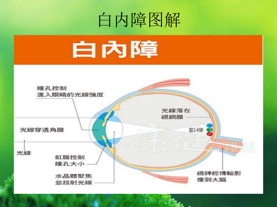 年龄相关性白内障.ppt_第2页