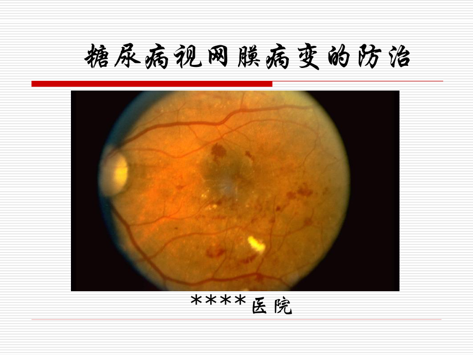 糖尿病视网膜病变宣教.ppt_第1页