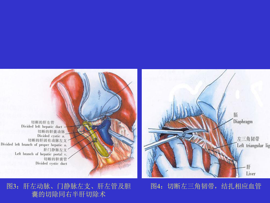 左半肝切除术1汇总.ppt_第2页