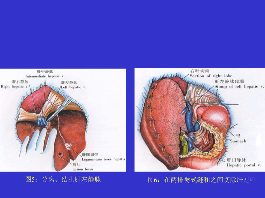 左半肝切除术1汇总.ppt_第3页