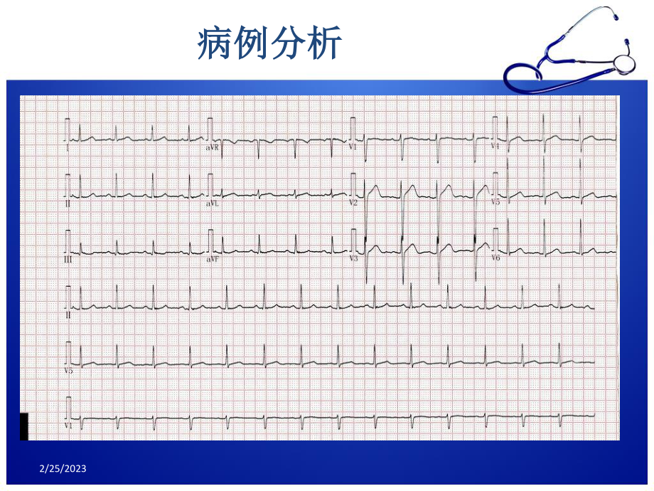 急性胸痛诊治流程.ppt_第3页