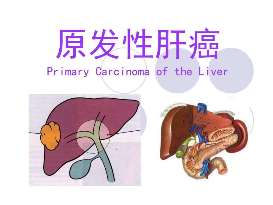 原发性肝癌-俞.ppt_第1页