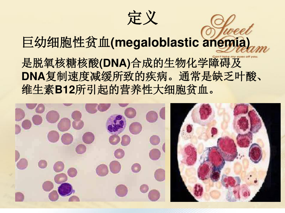 巨幼细胞性贫血.ppt_第3页