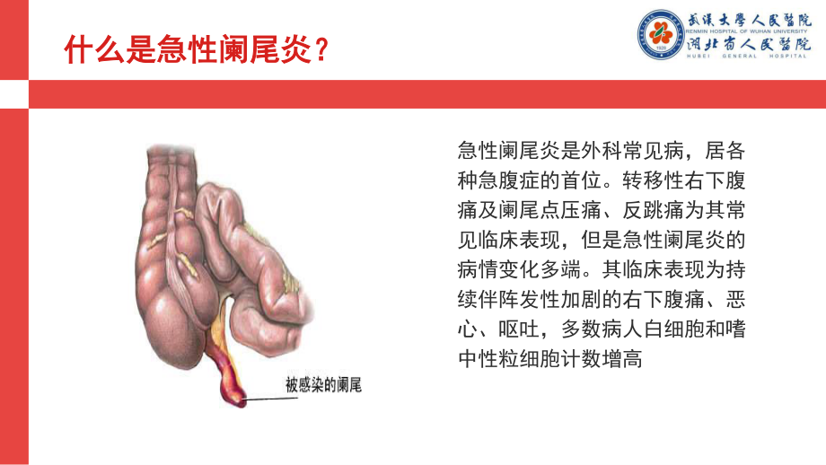 急性阑尾炎查房.pptx_第3页