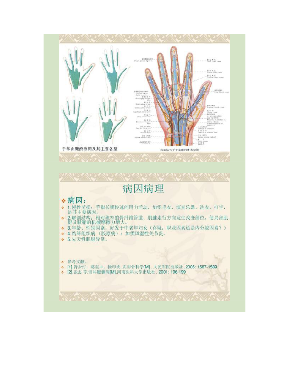 屈指肌狭窄性腱鞘炎解读.doc_第3页