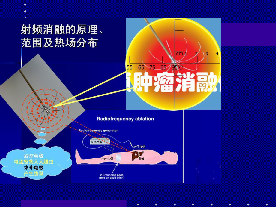 李可柔关于肝癌射频消融手术.ppt_第3页