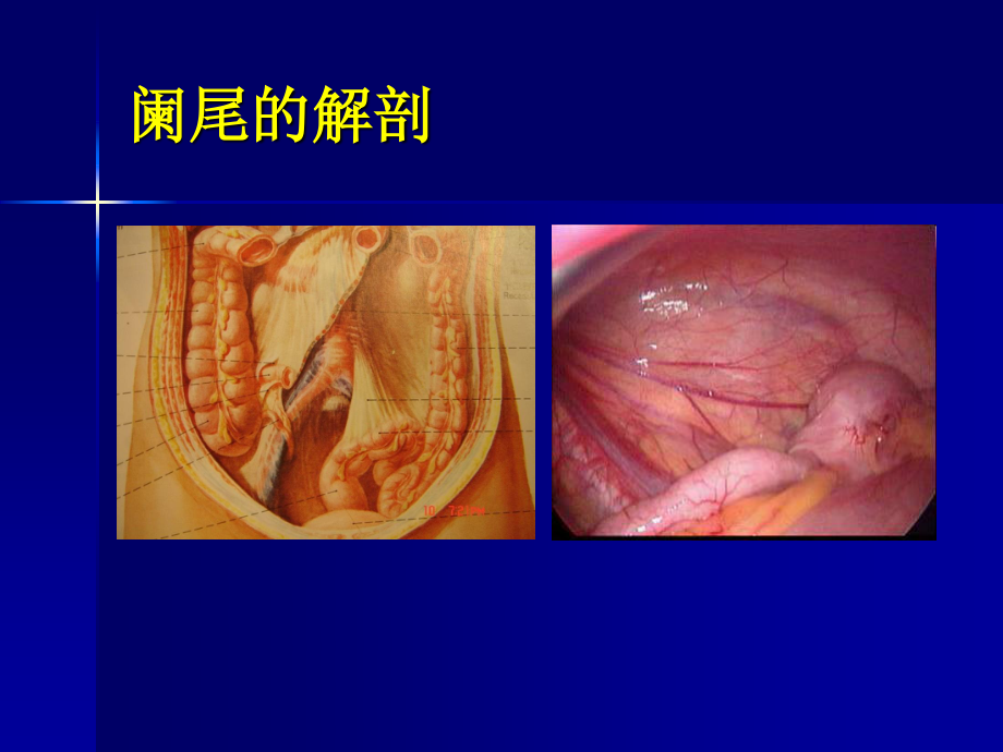 急性阑尾炎教学查房PPT.ppt_第2页