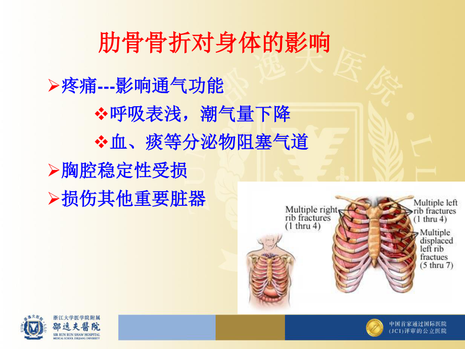 多根肋骨骨折胸腔不稳定型.ppt_第2页