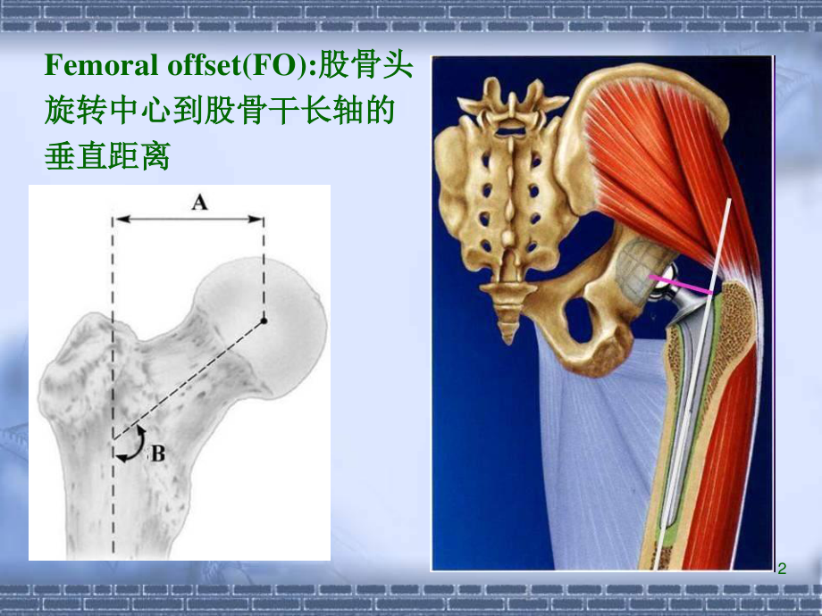 正常髋关节股骨偏心距的影像学研.ppt_第2页