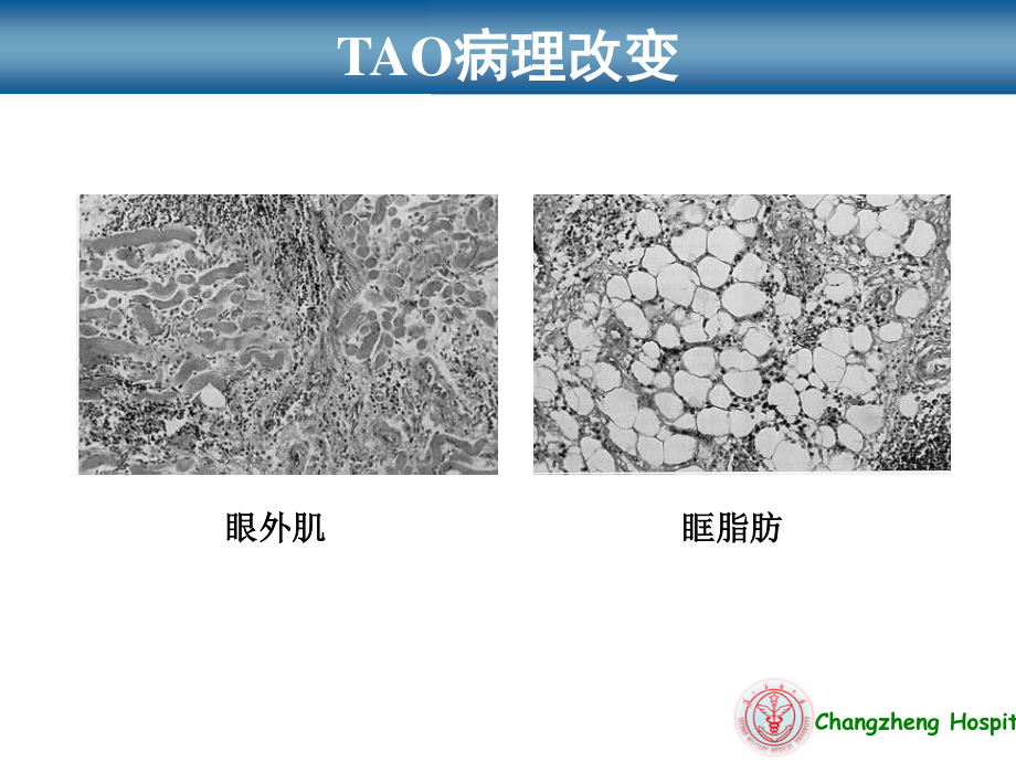 甲状腺相关性眼病新进展最终.ppt_第3页