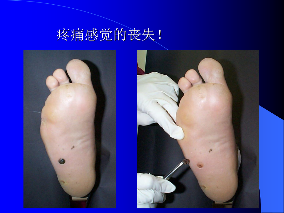 糖尿病足讲座2010-4.ppt_第3页