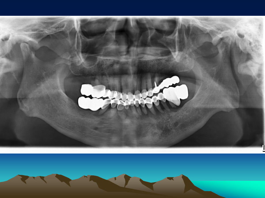口腔科门诊常见影像.ppt_第3页