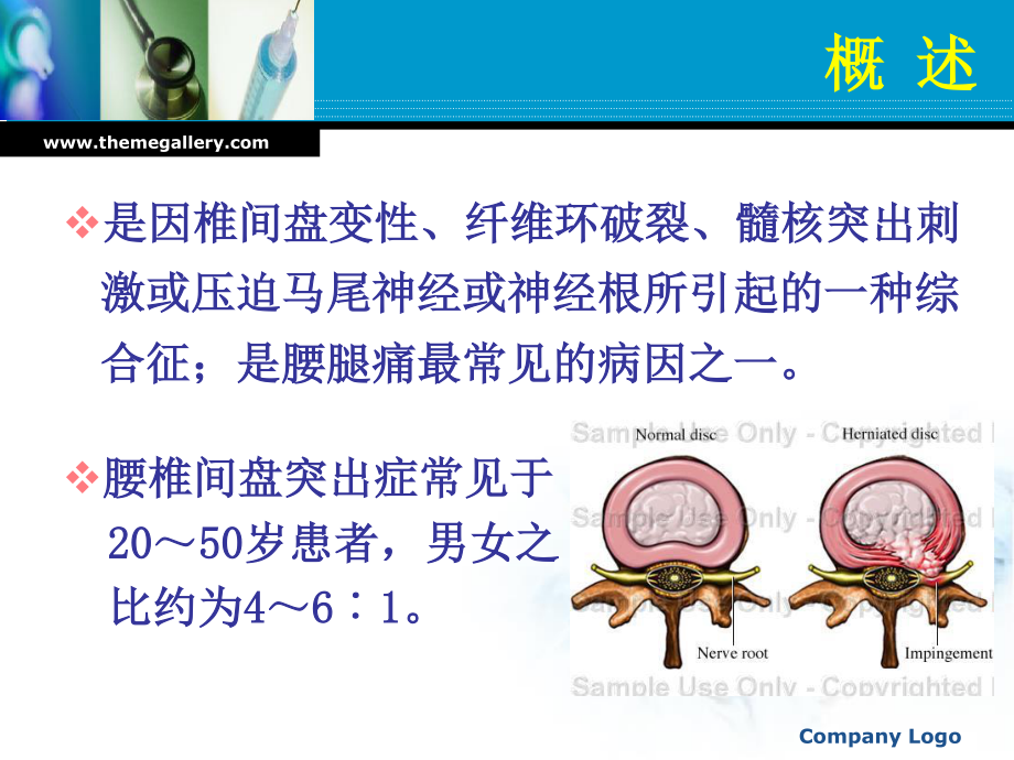 腰-椎-间-盘-突-出-症(欧).ppt_第2页