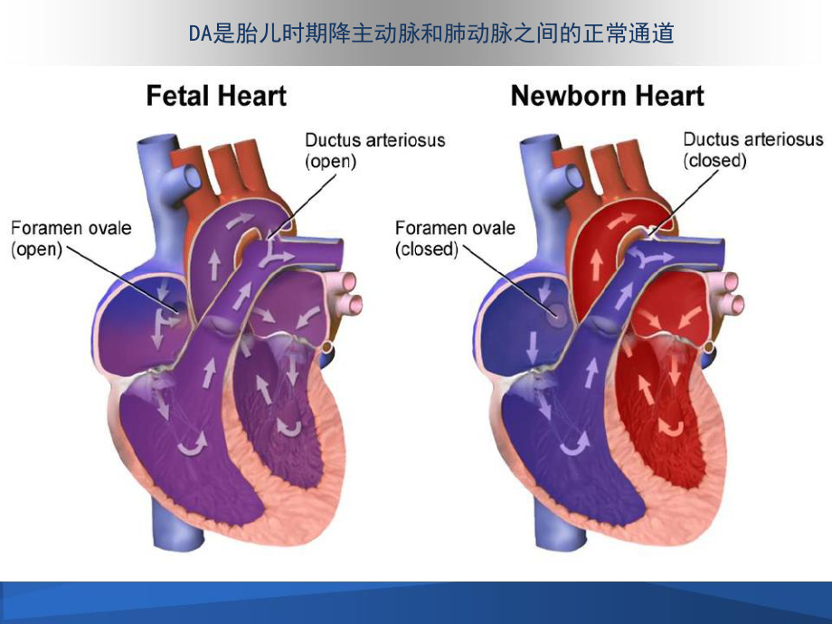 早产儿动脉导管开放.ppt_第2页