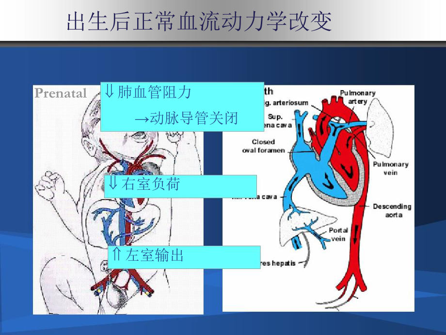 早产儿动脉导管开放.ppt_第3页