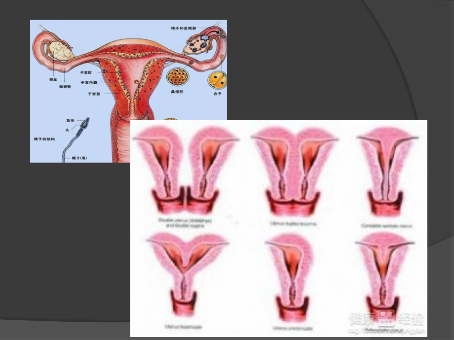 子宫畸形及三维成像.ppt_第3页