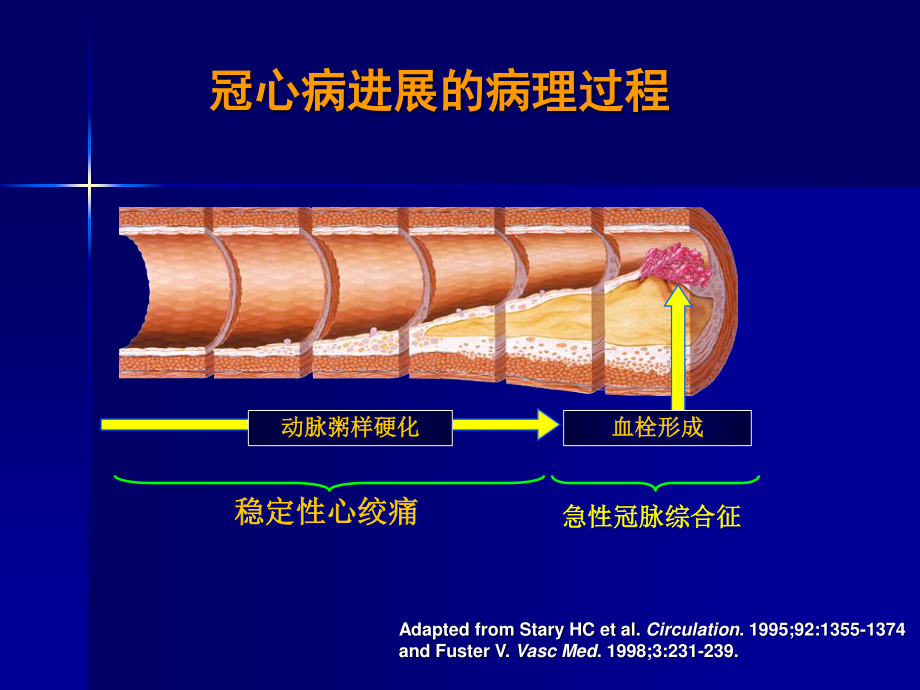 济南军区冠心病会议新乡卢才义.ppt_第3页