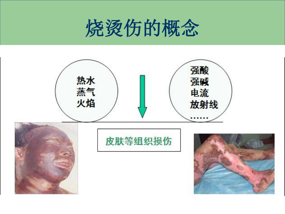 烧烫伤急救处理.ppt_第2页