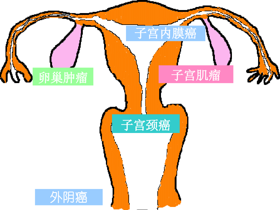 子宫颈癌-妇科知识.ppt_第1页