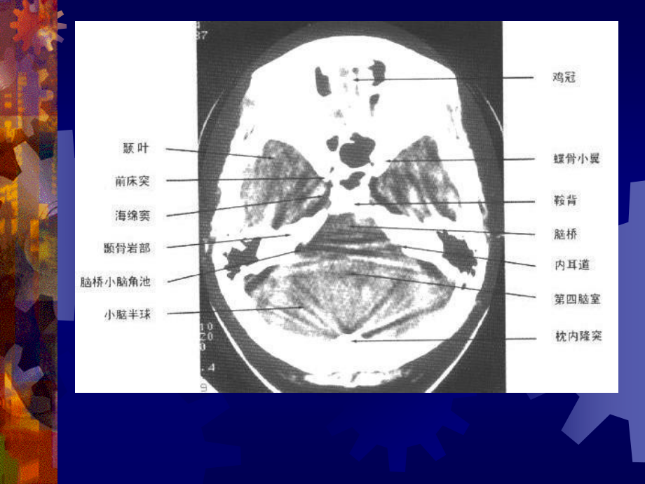 正-常-头-颅-CT-及-MRI-解-剖.ppt_第3页