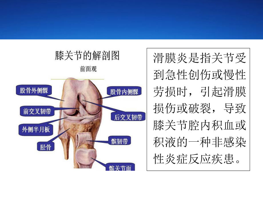 滑膜炎症状汇编.ppt_第2页