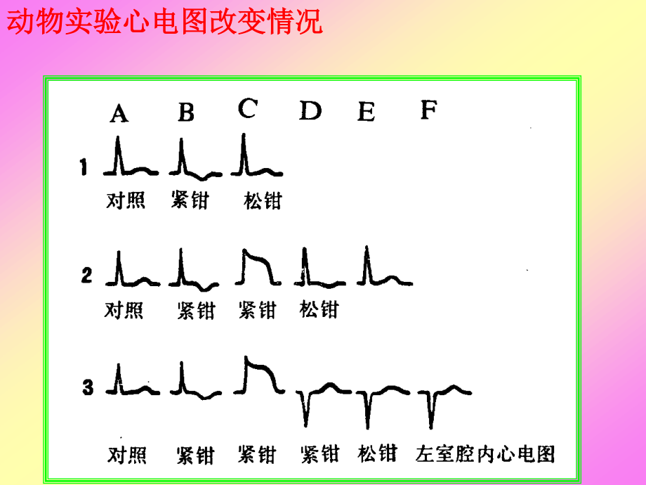 急性心肌梗死心电图演变.ppt_第3页