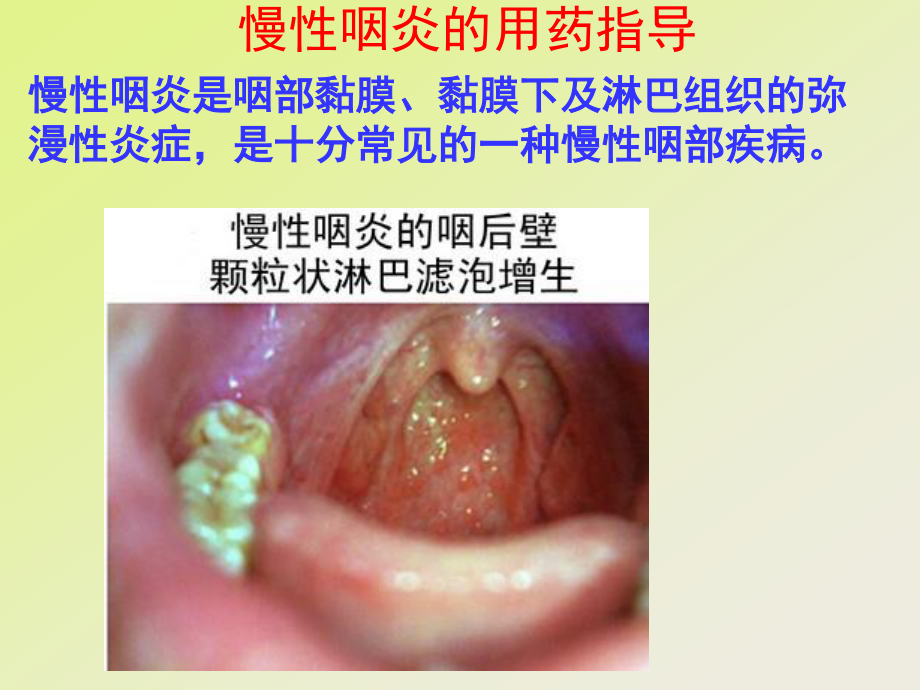 慢性咽炎的用药指导.ppt_第1页